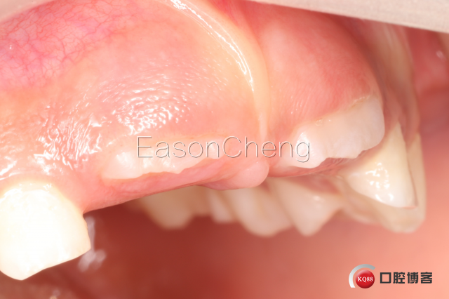 口腔无痛麻醉仪怎么用儿牙切开助萌术-表麻加持无痛麻醉仪——EasonCheng_https://www.jmylbn.com_新闻资讯_第15张