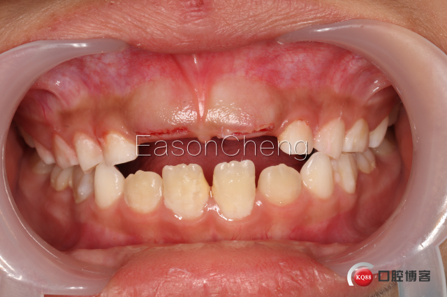 口腔无痛麻醉仪怎么用儿牙切开助萌术-表麻加持无痛麻醉仪——EasonCheng_https://www.jmylbn.com_新闻资讯_第9张