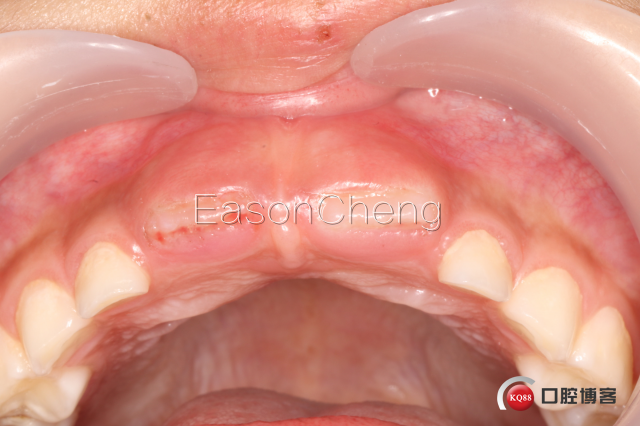 口腔无痛麻醉仪怎么用儿牙切开助萌术-表麻加持无痛麻醉仪——EasonCheng_https://www.jmylbn.com_新闻资讯_第12张