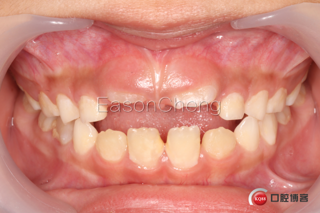 口腔无痛麻醉仪怎么用儿牙切开助萌术-表麻加持无痛麻醉仪——EasonCheng_https://www.jmylbn.com_新闻资讯_第16张