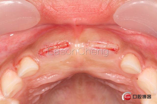 口腔无痛麻醉仪怎么用儿牙切开助萌术-表麻加持无痛麻醉仪——EasonCheng_https://www.jmylbn.com_新闻资讯_第10张