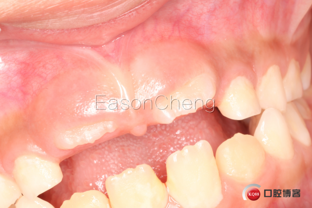 口腔无痛麻醉仪怎么用儿牙切开助萌术-表麻加持无痛麻醉仪——EasonCheng_https://www.jmylbn.com_新闻资讯_第17张