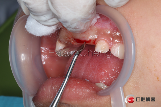 口腔无痛麻醉仪怎么用儿牙切开助萌术-表麻加持无痛麻醉仪——EasonCheng_https://www.jmylbn.com_新闻资讯_第6张