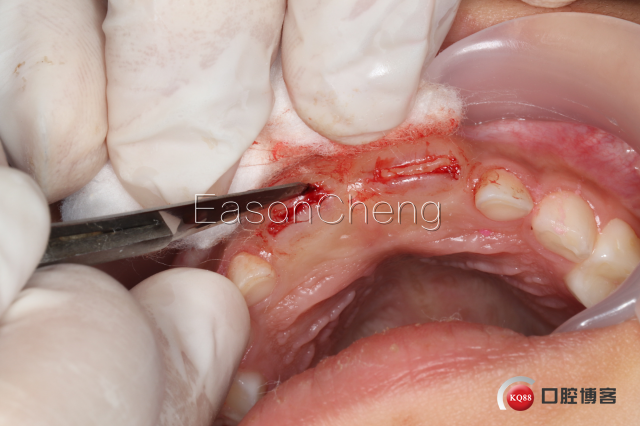 口腔无痛麻醉仪怎么用儿牙切开助萌术-表麻加持无痛麻醉仪——EasonCheng_https://www.jmylbn.com_新闻资讯_第7张