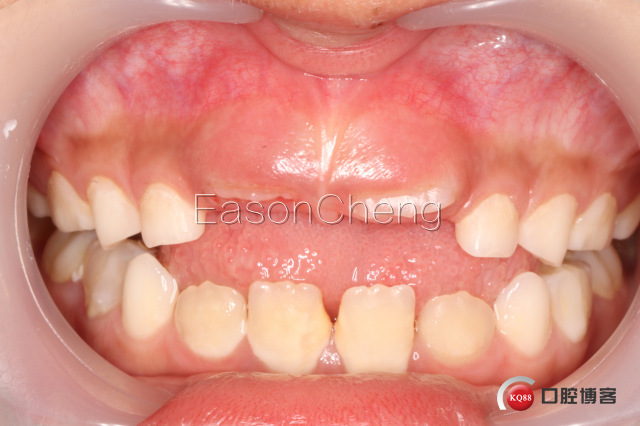 口腔无痛麻醉仪怎么用儿牙切开助萌术-表麻加持无痛麻醉仪——EasonCheng_https://www.jmylbn.com_新闻资讯_第11张