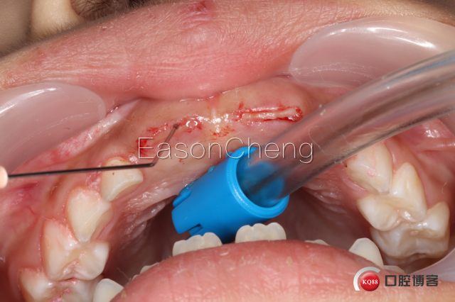 口腔无痛麻醉仪怎么用儿牙切开助萌术-表麻加持无痛麻醉仪——EasonCheng_https://www.jmylbn.com_新闻资讯_第8张