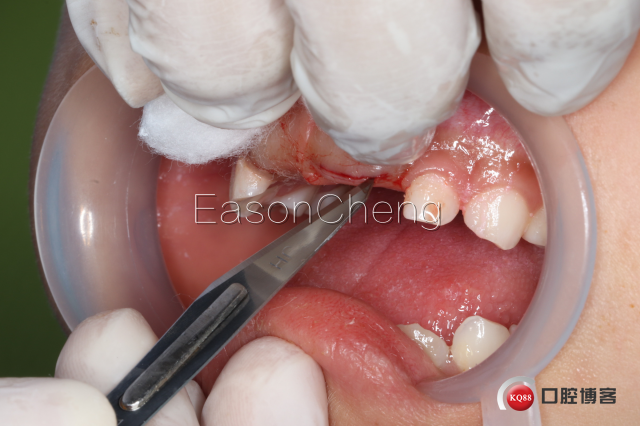 口腔无痛麻醉仪怎么用儿牙切开助萌术-表麻加持无痛麻醉仪——EasonCheng_https://www.jmylbn.com_新闻资讯_第5张