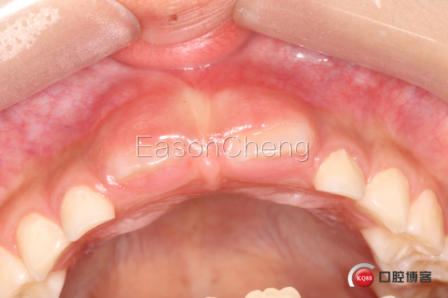 口腔无痛麻醉仪怎么用儿牙切开助萌术-表麻加持无痛麻醉仪——EasonCheng_https://www.jmylbn.com_新闻资讯_第14张