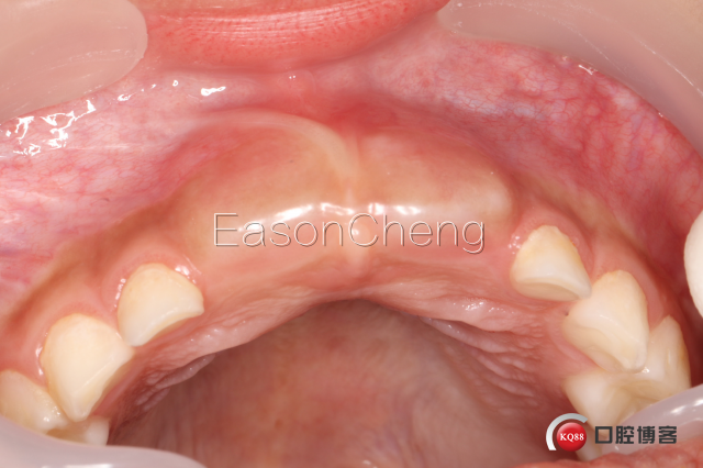 口腔无痛麻醉仪怎么用儿牙切开助萌术-表麻加持无痛麻醉仪——EasonCheng_https://www.jmylbn.com_新闻资讯_第3张