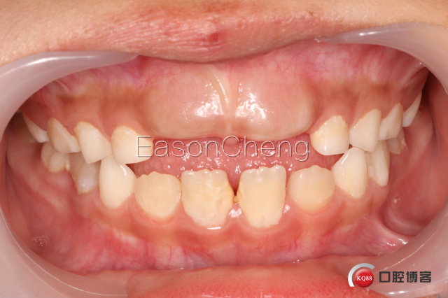 口腔无痛麻醉仪怎么用儿牙切开助萌术-表麻加持无痛麻醉仪——EasonCheng_https://www.jmylbn.com_新闻资讯_第2张