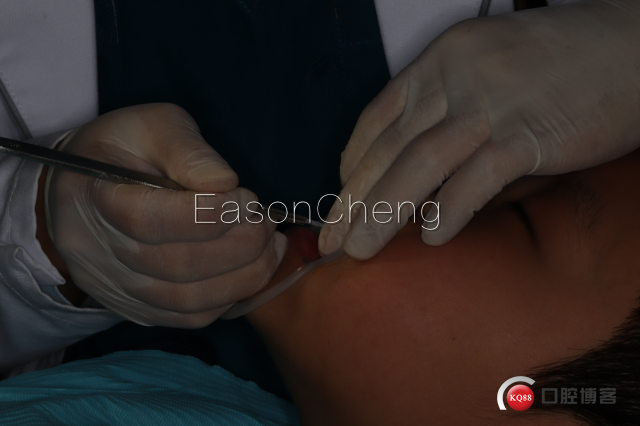 口腔无痛麻醉仪怎么用儿牙切开助萌术-表麻加持无痛麻醉仪——EasonCheng_https://www.jmylbn.com_新闻资讯_第4张