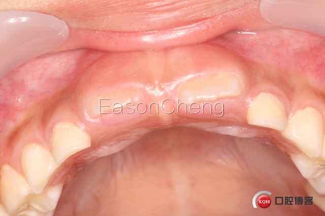 口腔无痛麻醉仪怎么用儿牙切开助萌术-表麻加持无痛麻醉仪——EasonCheng_https://www.jmylbn.com_新闻资讯_第18张