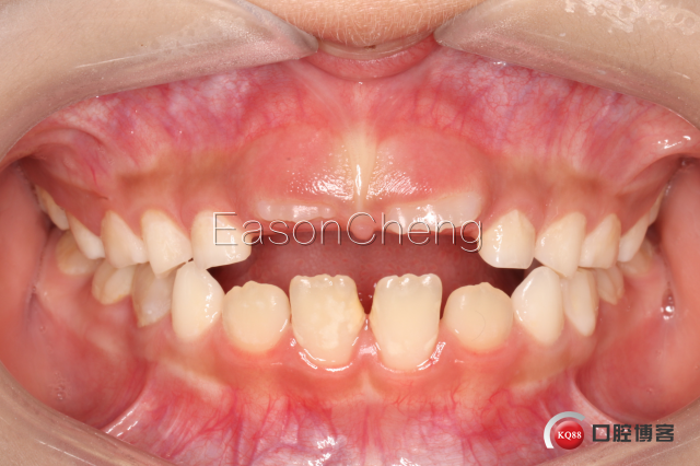 口腔无痛麻醉仪怎么用儿牙切开助萌术-表麻加持无痛麻醉仪——EasonCheng_https://www.jmylbn.com_新闻资讯_第13张