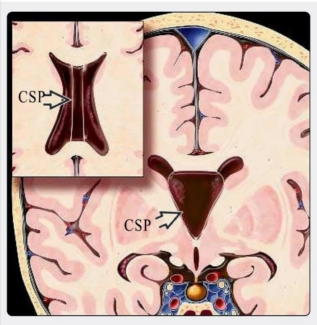 第五脑室是透明隔腔吗?_医学界-助力医生临床决策和职业成长