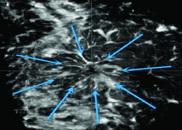 什么是超声容积探头市中医院引进乳腺检查新利器——自动乳腺全容积超声成像（ABVS）_https://www.jmylbn.com_新闻资讯_第3张