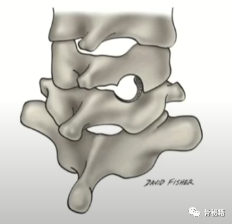 简单明了的脊柱减压技巧，骨科医生必看！