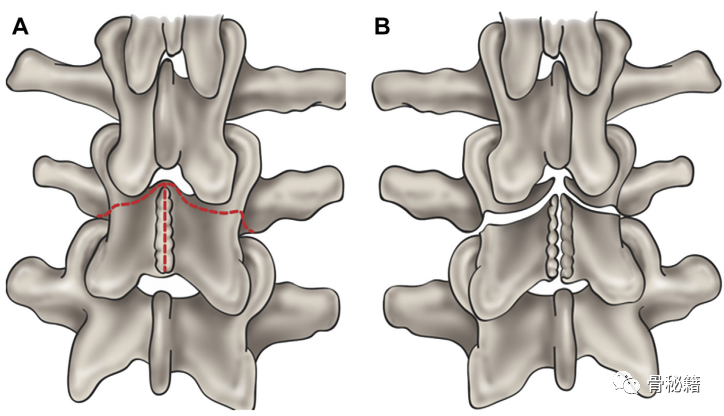 简单明了的脊柱减压技巧，骨科医生必看！