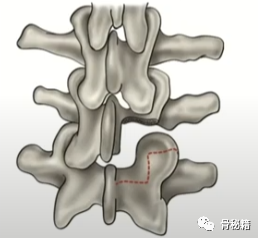 简单明了的脊柱减压技巧，骨科医生必看！