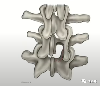 简单明了的脊柱减压技巧，骨科医生必看！