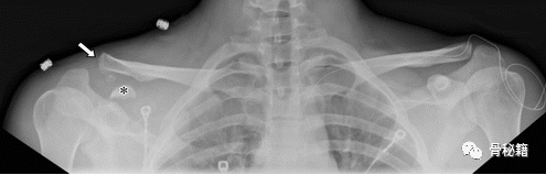 关于肩锁关节解剖与影像，一文了解！