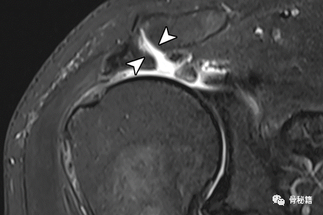 关于肩锁关节解剖与影像，一文了解！