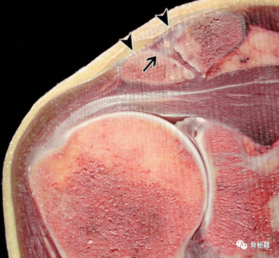 关于肩锁关节解剖与影像，一文了解！