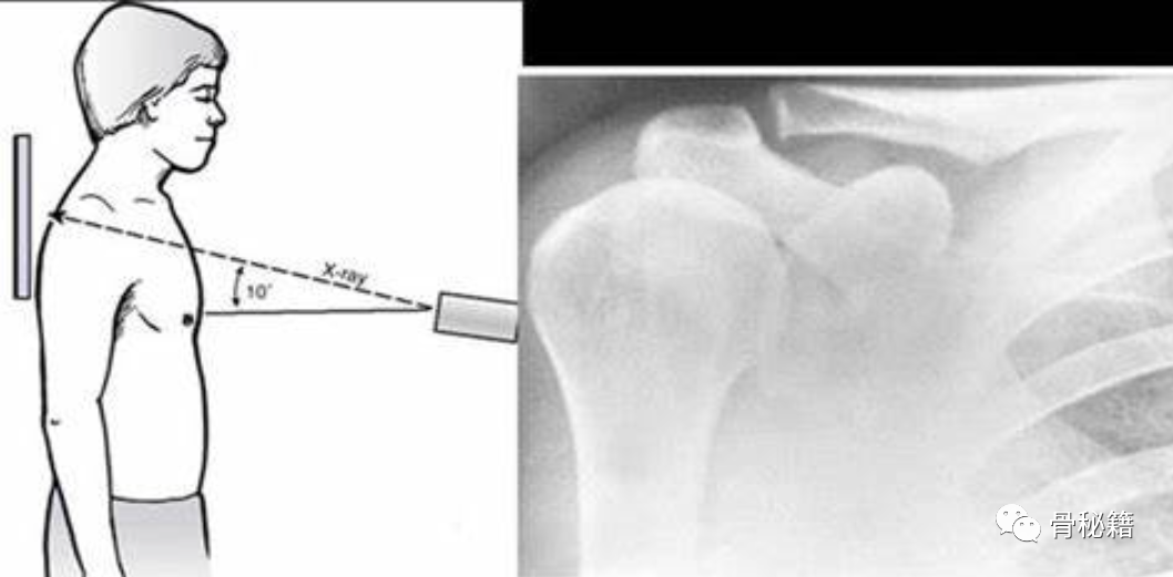 关于肩锁关节解剖与影像，一文了解！