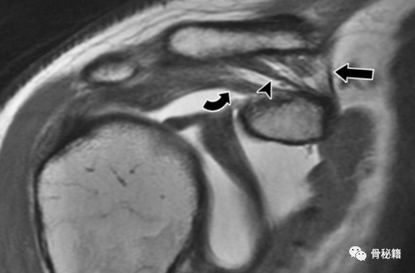关于肩锁关节解剖与影像，一文了解！