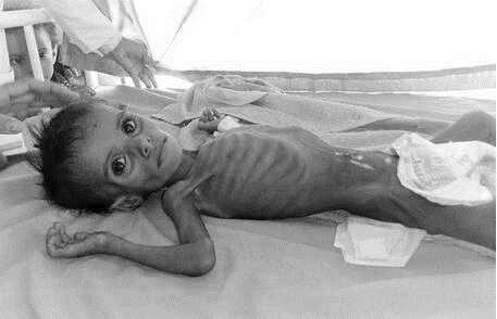 他们肌肉萎缩,体脂少,有明显的骨骼突出,头发干燥稀疏,甚至有低血压