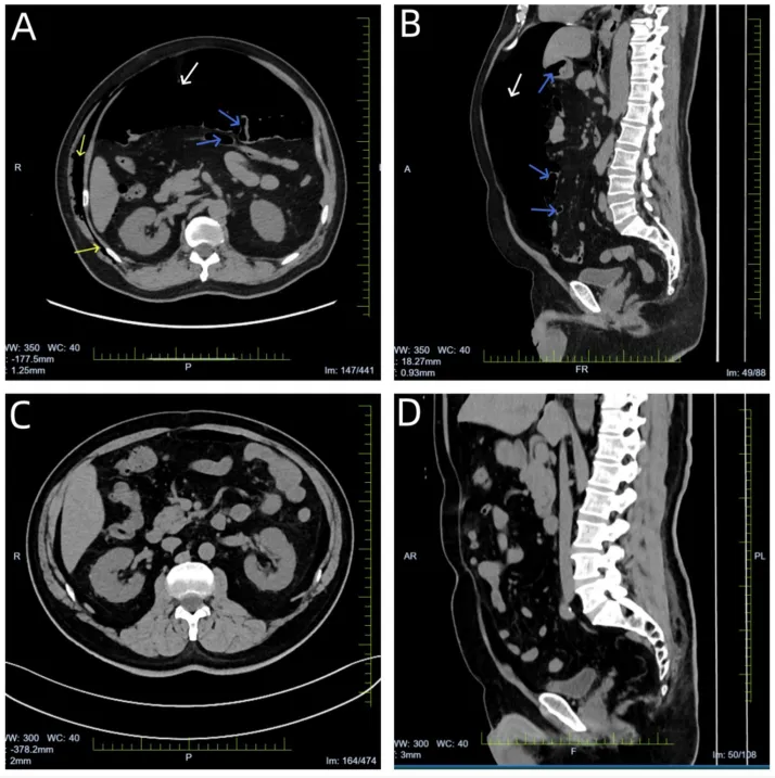 气腹管怎么接只因给氧方式不妥，气管镜术中病人突发腹胀、休克、呼吸衰竭_https://www.jmylbn.com_新闻资讯_第4张