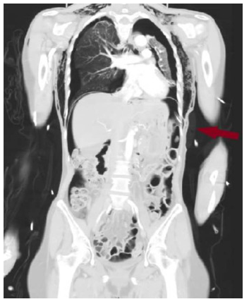 气腹管怎么接只因给氧方式不妥，气管镜术中病人突发腹胀、休克、呼吸衰竭_https://www.jmylbn.com_新闻资讯_第9张