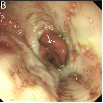 气腹管怎么接只因给氧方式不妥，气管镜术中病人突发腹胀、休克、呼吸衰竭_https://www.jmylbn.com_新闻资讯_第3张