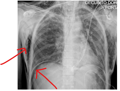 气腹管怎么接只因给氧方式不妥，气管镜术中病人突发腹胀、休克、呼吸衰竭_https://www.jmylbn.com_新闻资讯_第8张