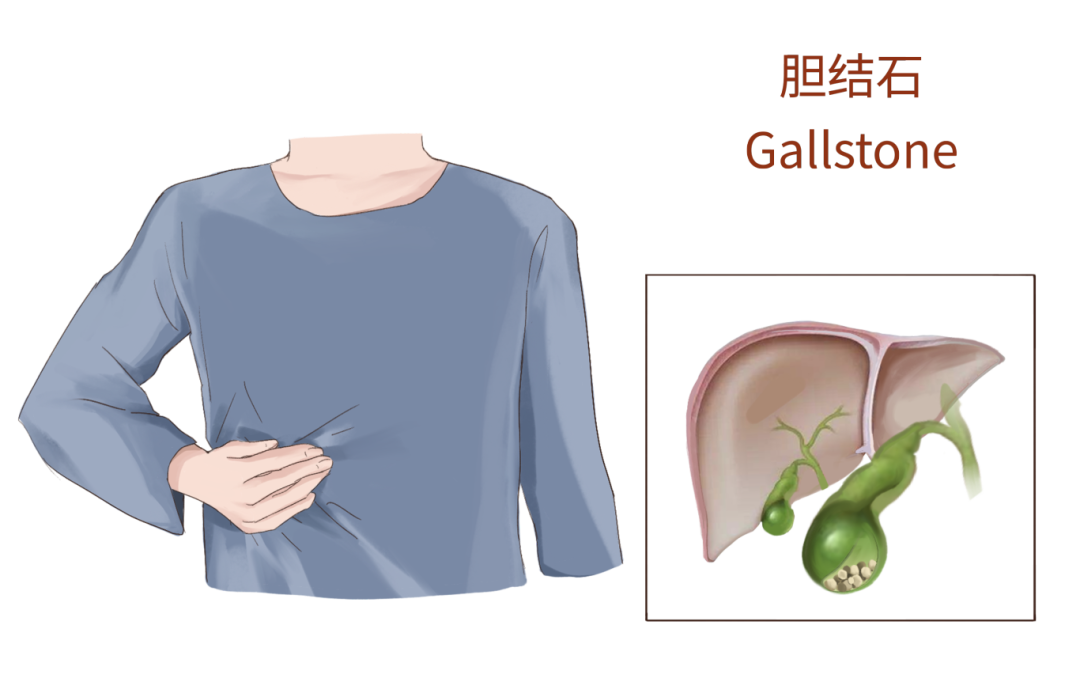 胆囊小石头