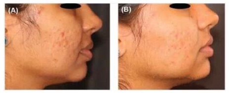 多极射频是什么射频可以改善哪些皮肤问题？医美射频和家用射频盘点_https://www.jmylbn.com_新闻资讯_第6张