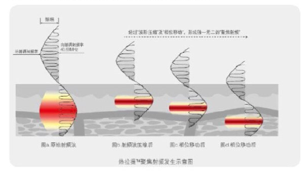 多极射频是什么射频可以改善哪些皮肤问题？医美射频和家用射频盘点_https://www.jmylbn.com_新闻资讯_第4张