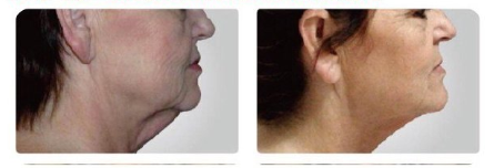 多极射频是什么射频可以改善哪些皮肤问题？医美射频和家用射频盘点_https://www.jmylbn.com_新闻资讯_第1张