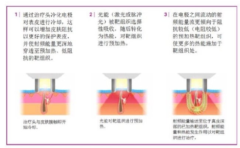 多极射频是什么射频可以改善哪些皮肤问题？医美射频和家用射频盘点_https://www.jmylbn.com_新闻资讯_第5张