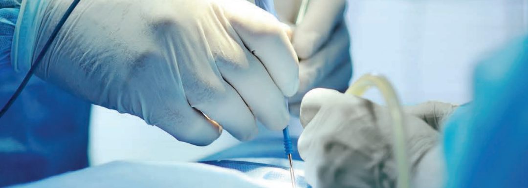 为什么手术用电刀高频电刀——取代机械手术刀的电外科器械_https://www.jmylbn.com_新闻资讯_第5张