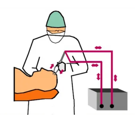 为什么手术用电刀高频电刀——取代机械手术刀的电外科器械_https://www.jmylbn.com_新闻资讯_第3张