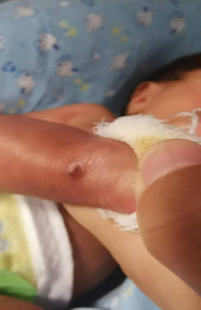 穿刺鞘英文怎么写新生儿穿刺点结黑痂，美小护这样做，6天后痊愈！_https://www.jmylbn.com_新闻资讯_第7张