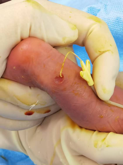 穿刺鞘英文怎么写新生儿穿刺点结黑痂，美小护这样做，6天后痊愈！_https://www.jmylbn.com_新闻资讯_第4张