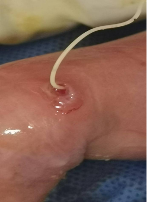 穿刺鞘英文怎么写新生儿穿刺点结黑痂，美小护这样做，6天后痊愈！_https://www.jmylbn.com_新闻资讯_第6张