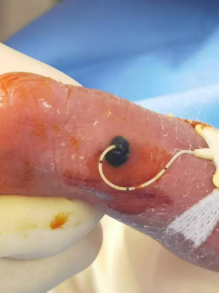 穿刺鞘英文怎么写新生儿穿刺点结黑痂，美小护这样做，6天后痊愈！_https://www.jmylbn.com_新闻资讯_第3张