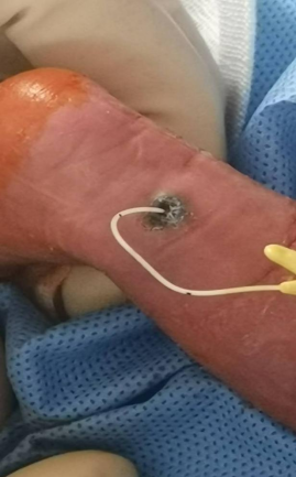 穿刺鞘英文怎么写新生儿穿刺点结黑痂，美小护这样做，6天后痊愈！_https://www.jmylbn.com_新闻资讯_第5张