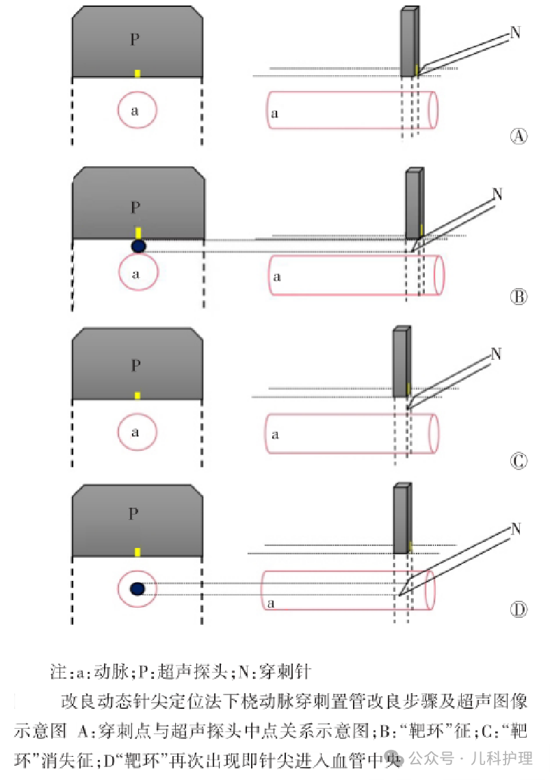 留置针型号怎么区分一文Get儿童桡动脉置管技巧_https://www.jmylbn.com_新闻资讯_第5张