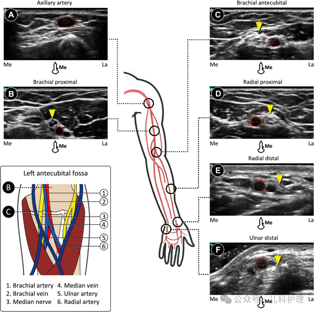 留置针型号怎么区分一文Get儿童桡动脉置管技巧_https://www.jmylbn.com_新闻资讯_第7张