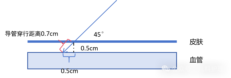 留置针型号怎么区分一文Get儿童桡动脉置管技巧_https://www.jmylbn.com_新闻资讯_第3张