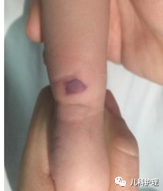 为什么泵输液如何有效预防微量输液泵致婴幼儿输液外渗？_https://www.jmylbn.com_新闻资讯_第2张