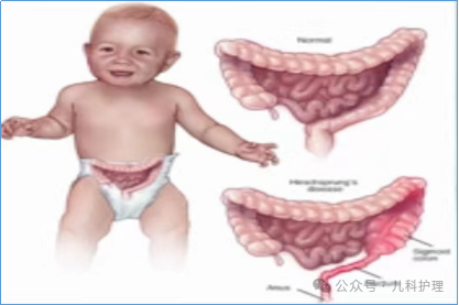 结肠灌洗怎么做儿科改善护理服务行动——小儿“肠道清洁”，我们这样做_https://www.jmylbn.com_新闻资讯_第2张